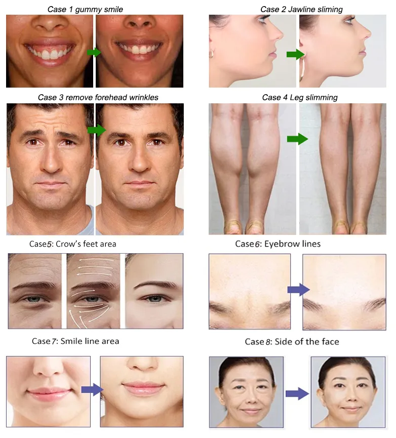 ضد چروک های لاغری Beutox Batulaxs Resty Filler Juvederms 1